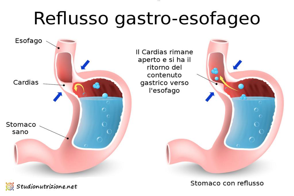 reflusso gastro esofageo
