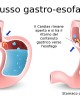 Reflusso gastro esofageo